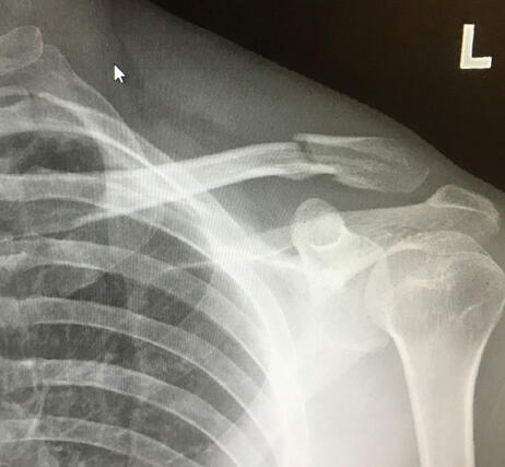 Broken collar bone